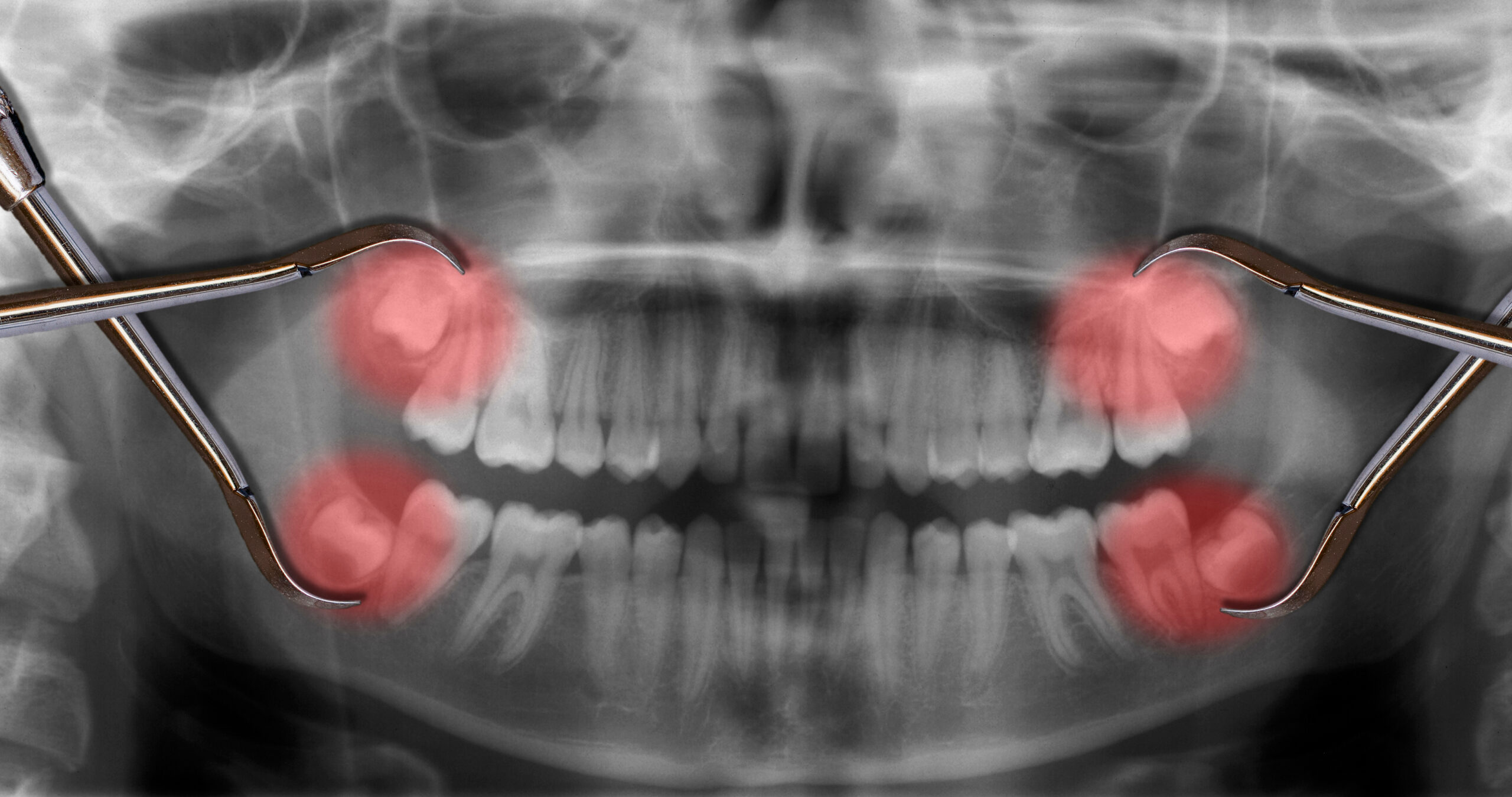 有明　歯医者　親知らず抜歯の豊富な実績